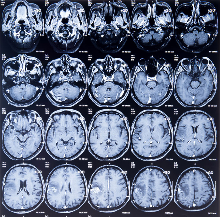 Multiple-Sclerosis-Clinical-Trials Multiple-Sclerosis-Clinical-Trials