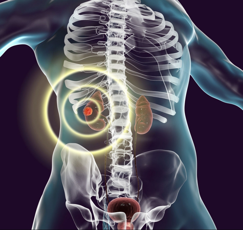 Biorasi Brings Challenging CKD Studies Under Control Biorasi Brings Challenging CKD Studies Under Control
