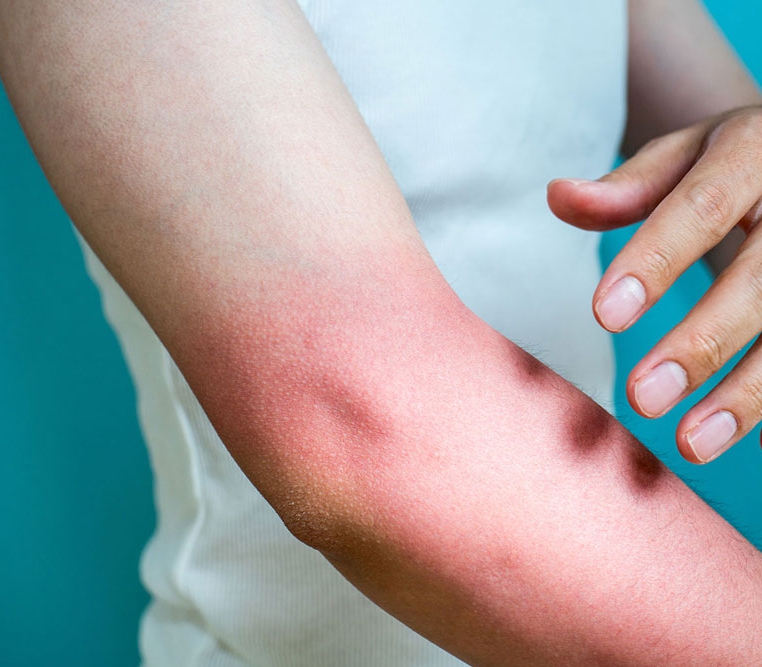 Biorasi Brings Smart Solutions to Your Plaque Psoriasis Trials Biorasi Brings Smart Solutions to Your Plaque Psoriasis Trials